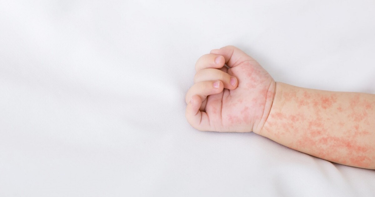 Autoridades descartan epidemia de Coxsackie en Puebla; suman 29 brotes y 200 casos en lo que va del año