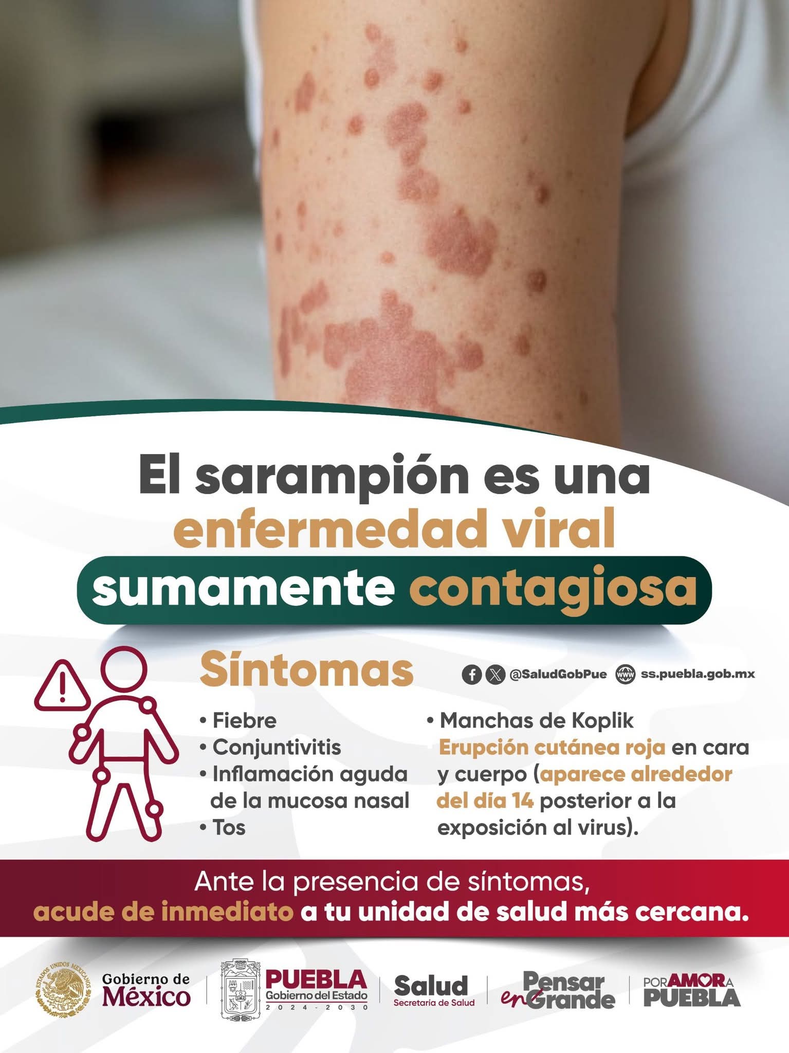 Texmelucan refuerza medidas sanitarias ante segundo caso de sarampión en Puebla